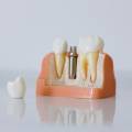 Cómo cuidar tus implantes dentales en verano: consejos de tu dentista en Móstoles