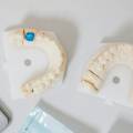 Ventajas de la implantología dental
