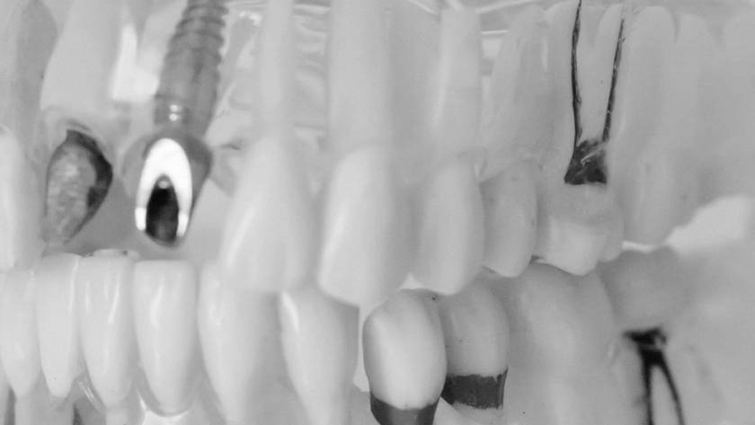 Implantes dentales Móstoles
