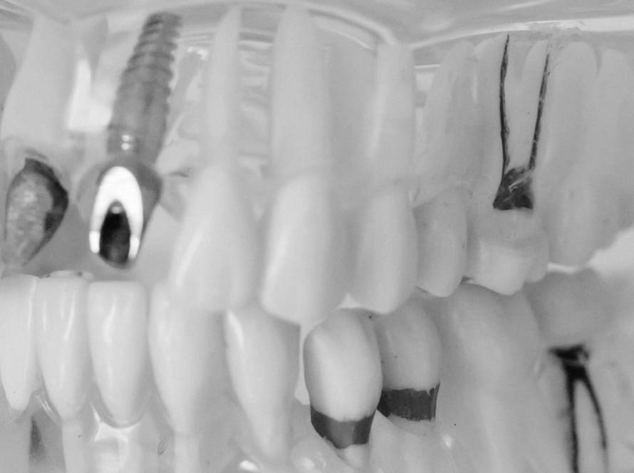 Implantes dentales Móstoles