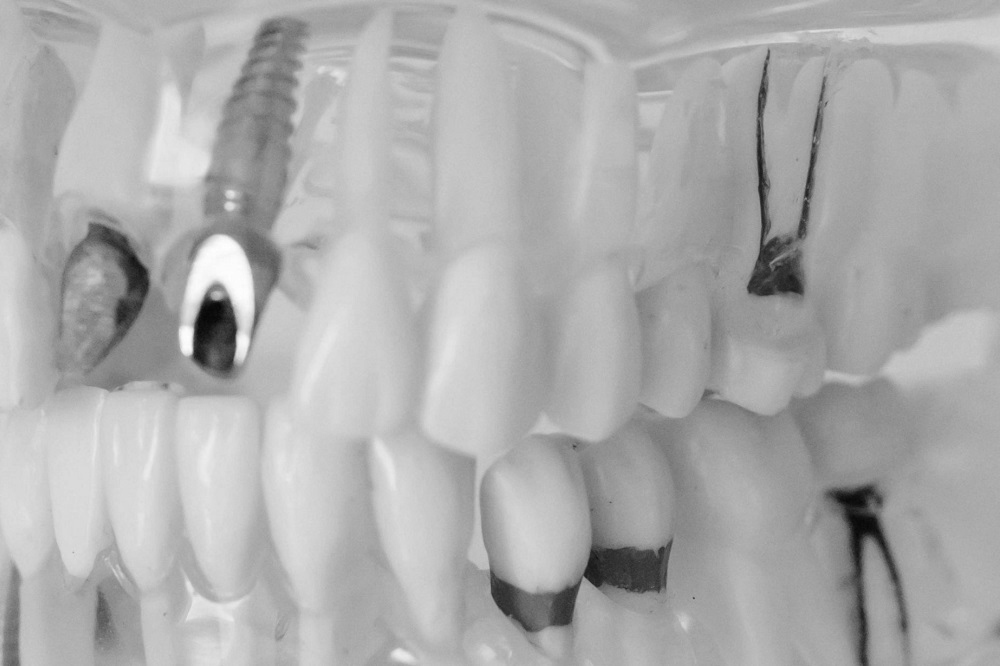 Implantes dentales Móstoles